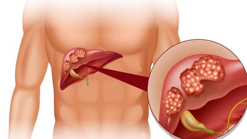 Những biến chứng của nóng gan