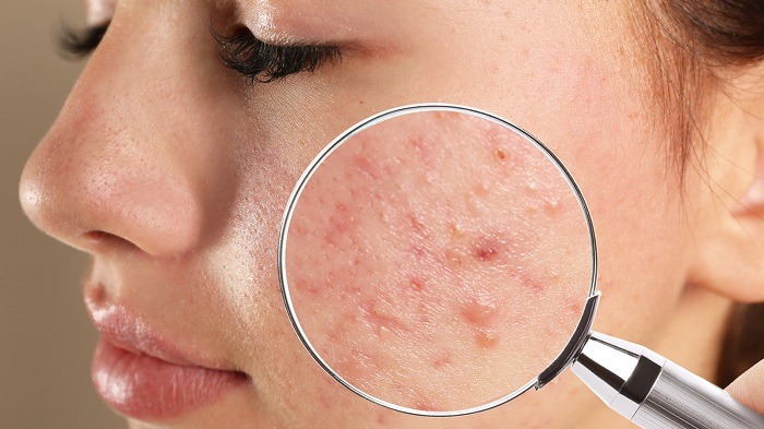 Serum trị mụn giúp làm khô nhân mụn và tiêu viêm hiệu quả