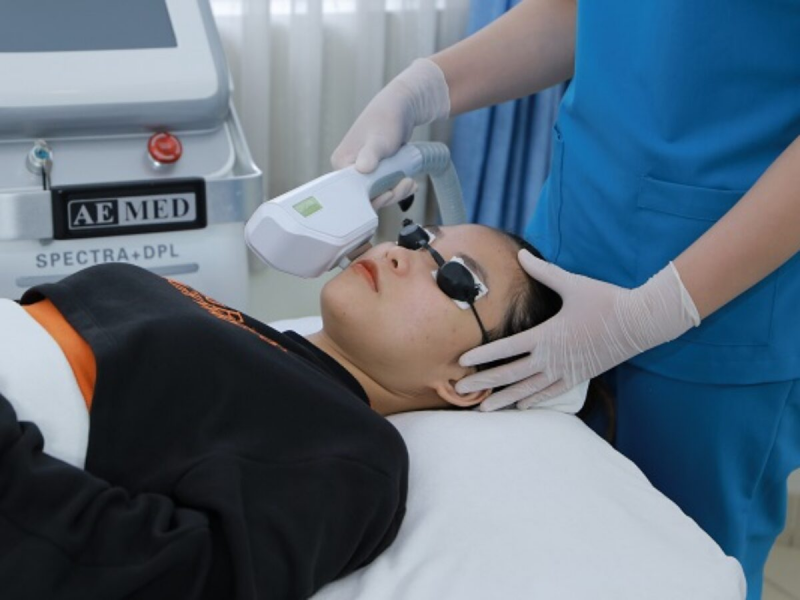  Điều trị bằng phương pháp IPL