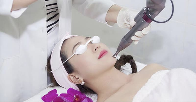 Laser điều trị nám