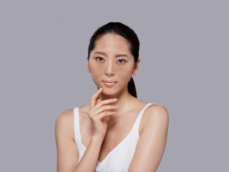 Dấu hiệu nhận biết nám da