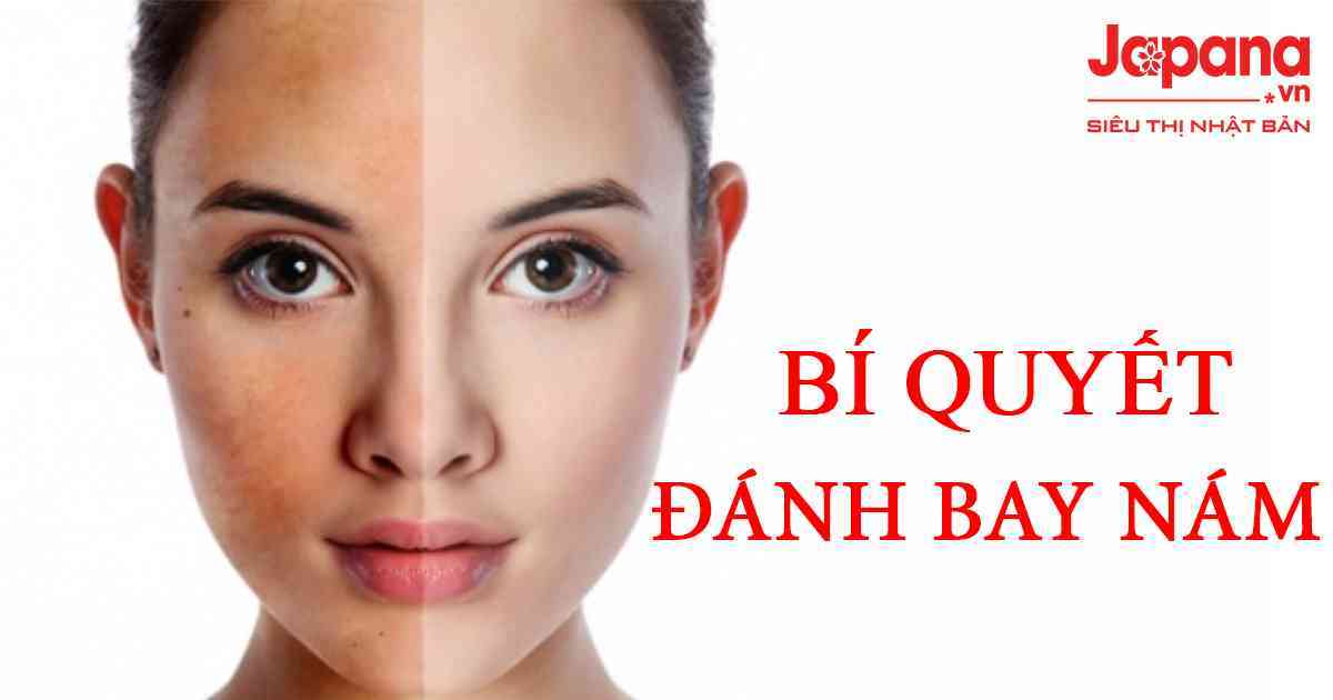 Bí quyết trị nám da hiệu quả, ngăn ngừa nám quay trở lại