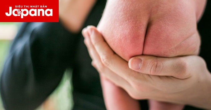 Tã Nhật có khiến bé bị hăm da không?