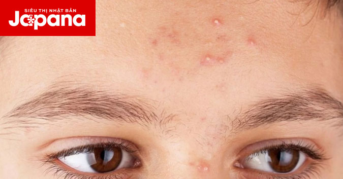 Nguyên nhân và cách điều trị mụn trứng cá ở trán