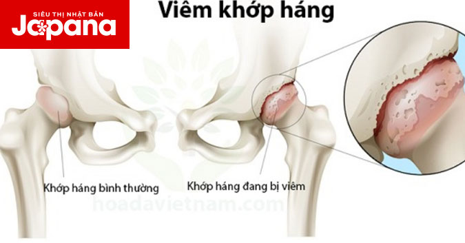 Nguyên nhân và cách điều trị bệnh viêm khớp háng
