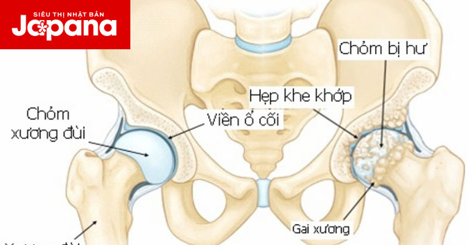 Những dấu hiệu và nguyên nhân điều trị bệnh thoái hóa khớp háng