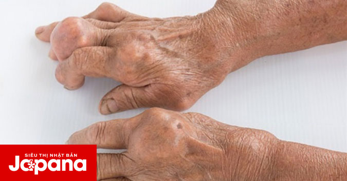 Những biến chứng nguy hiểm thường gặp của bệnh gout