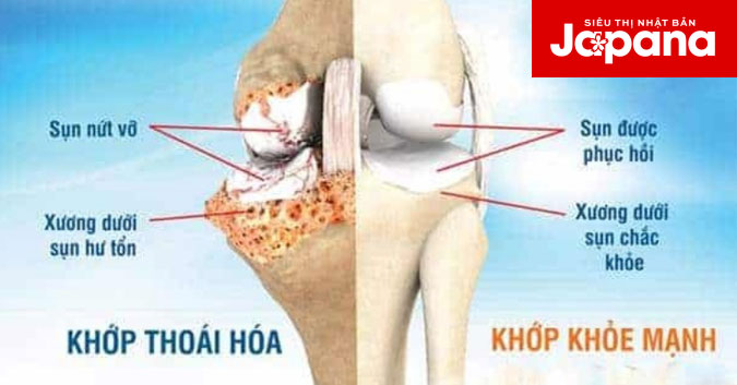 Top 4 bài tập Yoga dành cho người bị thoái hóa khớp gối
