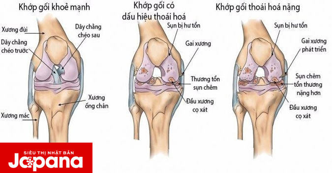 7 loại thực phẩm rất tốt cho người bị thoái hóa khớp gối