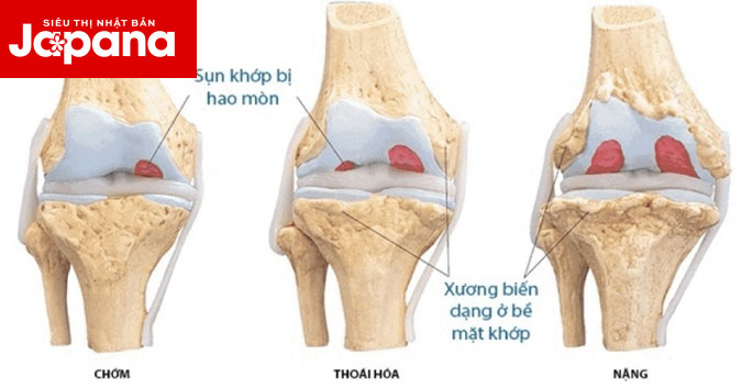 Người bị viêm xương khớp nên ăn những gì?
