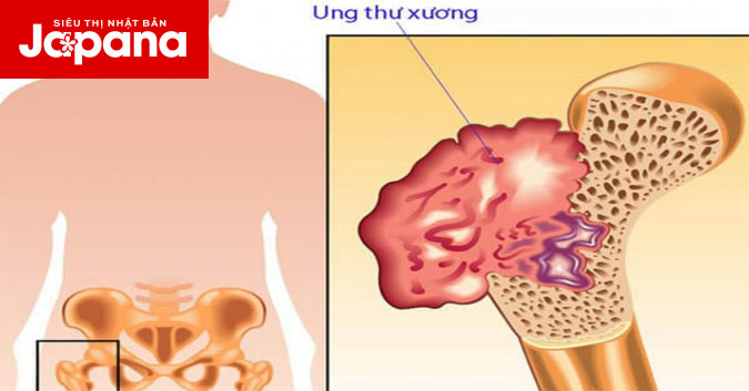 Bạn biết gì về căn bệnh ung thư xương?