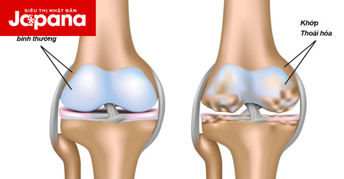Thoái hóa khớp ở người cao tuổi