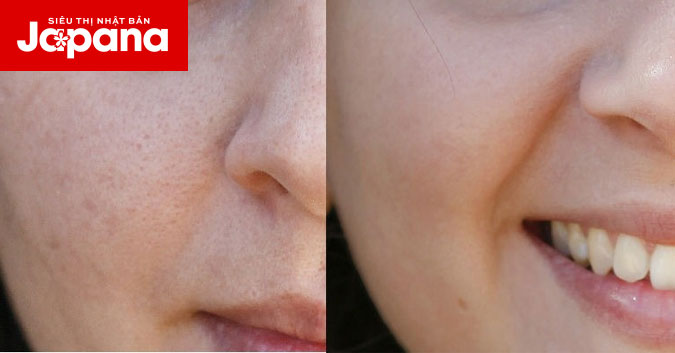 Chia sẻ 10 mẹo se khít lỗ chân lông giúp bạn luôn rạng ngời