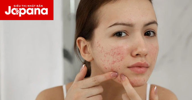 Mụn trứng cá tấn công vì 7 sai lầm trong chăm sóc da bạn không ngờ