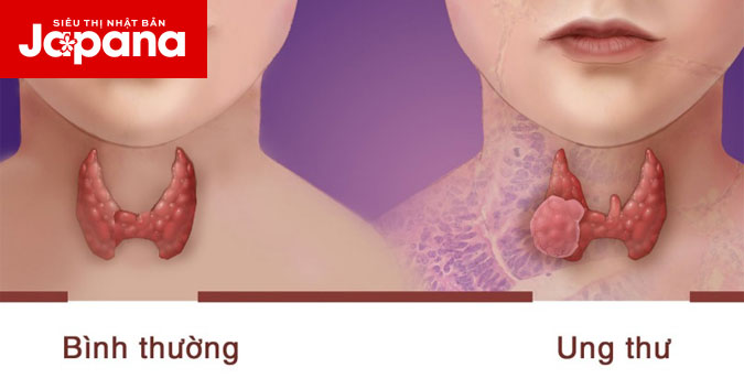 Các căn bệnh ung thư thường gặp ở phụ nữ
