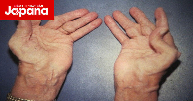 Viêm khớp dạng thấp sẽ gây cho bạn nhiều hậu quả nguy hiểm