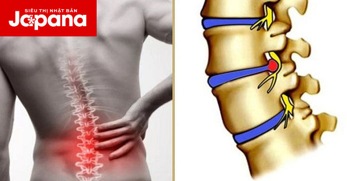 Bệnh thoát vị đĩa đệm lưng có những dấu hiệu nào phổ biến
