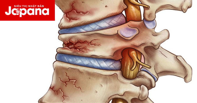 Tất tần tật về xẹp đốt sống