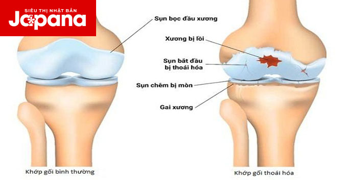 Thoái hoá khớp có những biến chứng gì?