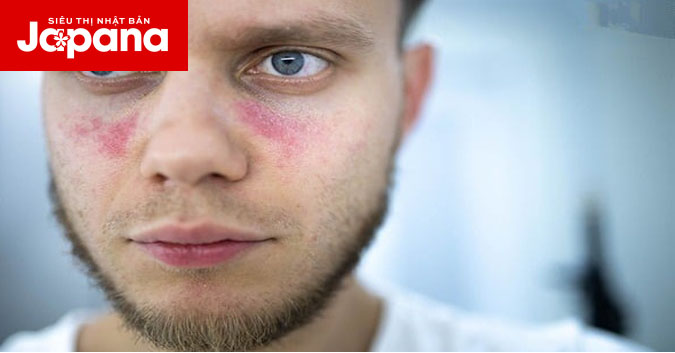 Bệnh Lupus ban đỏ có ảnh hưởng gì đến xương khớp hay không?