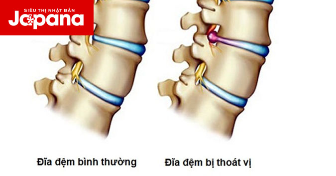 Phương pháp đẩy lùi thoát vị đĩa đệm mà không cần phẫu thuật hay uống thuốc