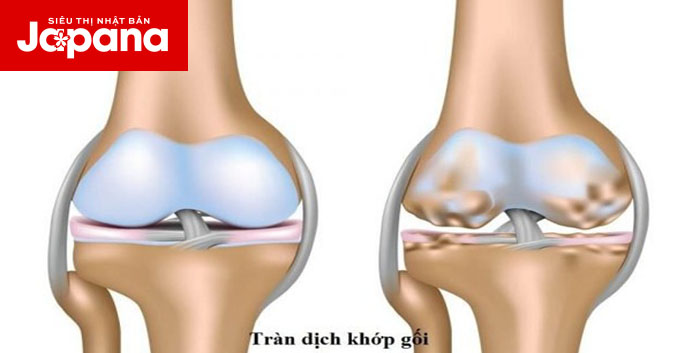 Nguyên nhân và cách điều trị khi bị tràn dịch khớp gối