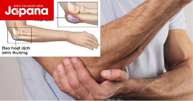 Những thông tin bạn cần biết về viêm bao hoạt dịch