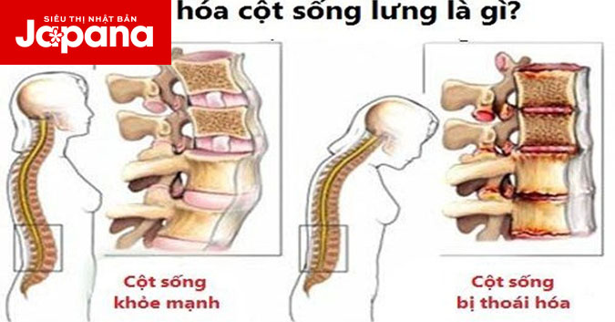 Tất tần tật về thoái hoá cột sống lưng bạn cần biết