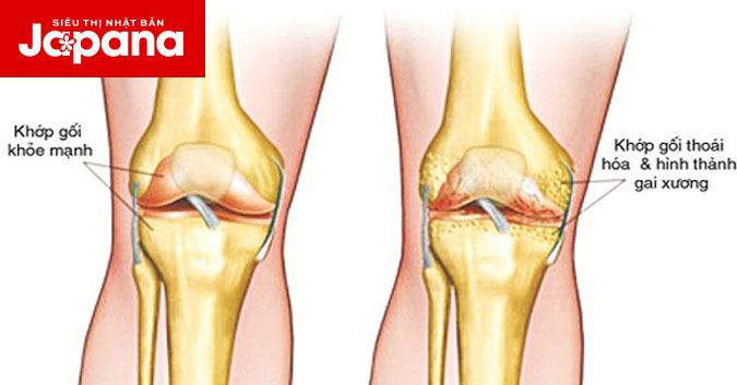 Những điều bạn cần biết về thoái hoá khớp gối