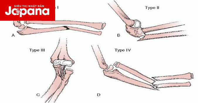 Những điều bạn cần biết khi bị gãy Monteggia