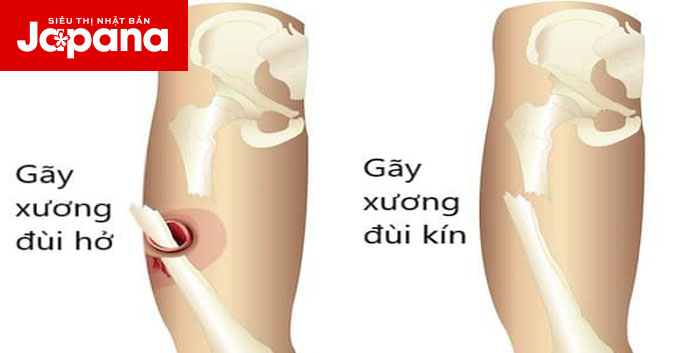 Đừng chủ quan tình trạng gãy xương đùi