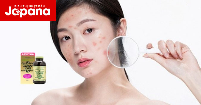 Tảo xoắn có trị mụn không?