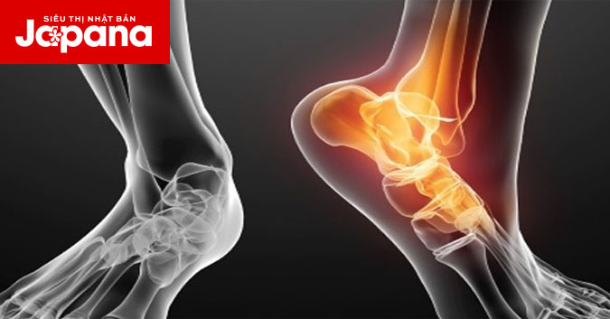 3 sai lầm thường mắc phải khi xử lý chấn thương trật khớp bàn chân
