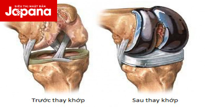 Sau phẫu thuật thay khớp gối có nên tập vật lý trị liệu hay không?