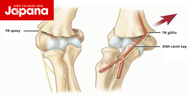 Cảnh báo trẻ em có nguy cơ gãy liên lồi cầu xương cánh tay