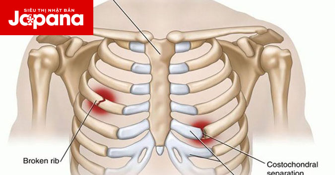 Những điều bạn cần biết về gãy xương sườn