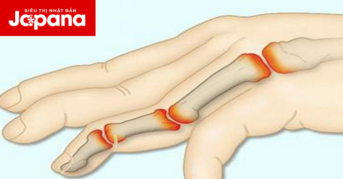 Phòng tránh thoái hoá khớp bàn ngón tay hiệu quả