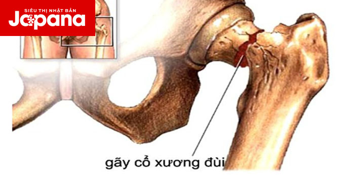 Gãy cổ xương đùi có nguy hiểm hay không?