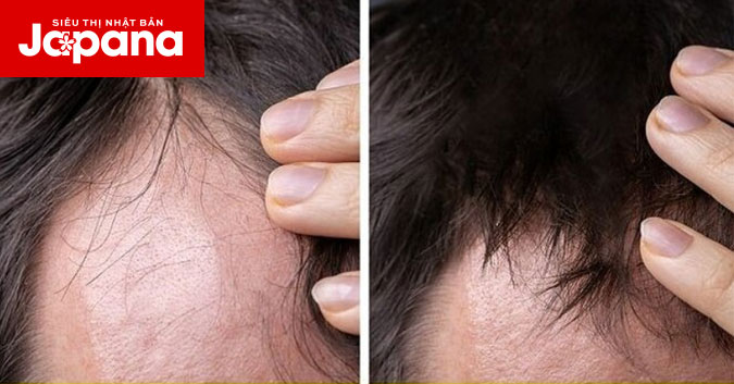 Giảm tóc gãy rụng với tuyệt chiêu của người Ấn Độ