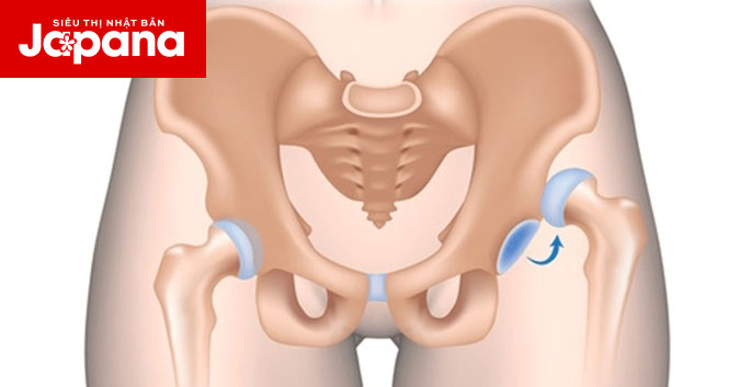 Nguyên nhân và phương pháp điều trị trật khớp háng