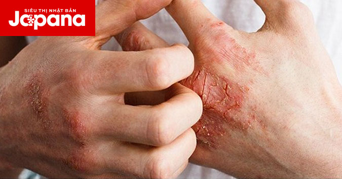 Nguyên nhân, triệu chứng và phương pháp điều trị viêm khớp vảy nến