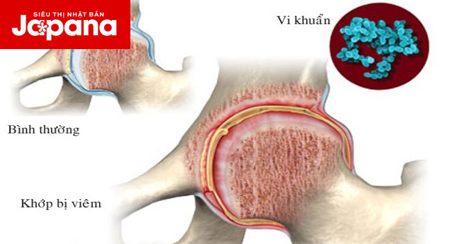 Nguyên nhân và cách điều trị viêm khớp nhiễm khuẩn