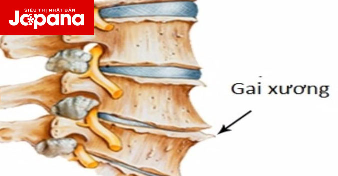Các triệu chứng của gai cột sống cổ, lưng qua các giai đoạn