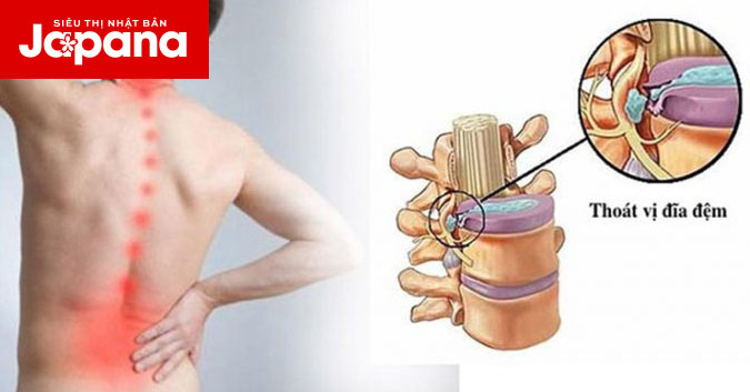 3 phương pháp để giảm thoát vị đĩa đệm thường gặp