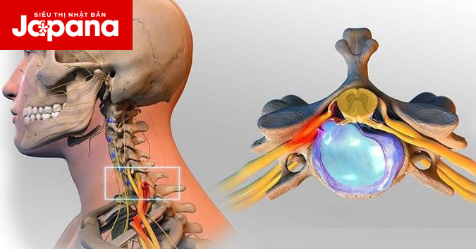 Biểu hiện của thoát vị đĩa đệm cột sống cổ