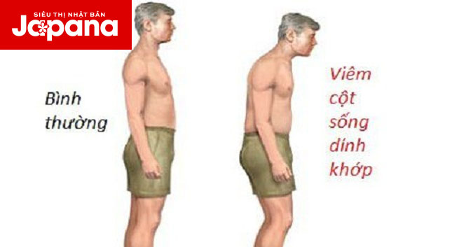 Cần điều trị bệnh viêm cột sống dính khớp sớm để ngăn ngừa tàn phế