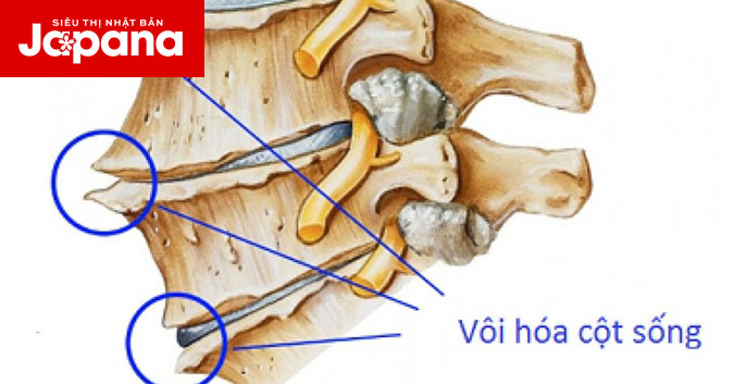 Vôi hoá cột sống là bệnh gì và hướng khắc phục