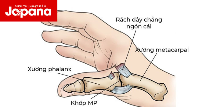 Viêm khớp ngón tay cái có các triệu chứng nào thường gặp?