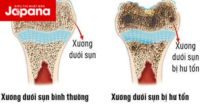 Sụn và xương dưới sụn ảnh hưởng đến khớp như thế nào?