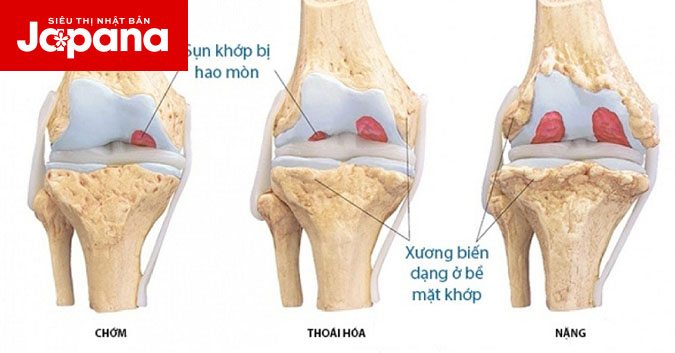Chăm sóc sụn khớp tốt để quá trình thoái hoá khớp diễn ra chậm hơn